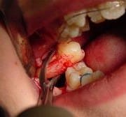 DentalSurgicalExtraction