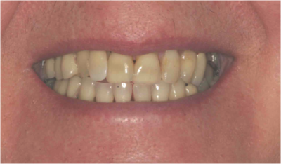 Teeth After Corrective Work Gaps Missing Richmond Va