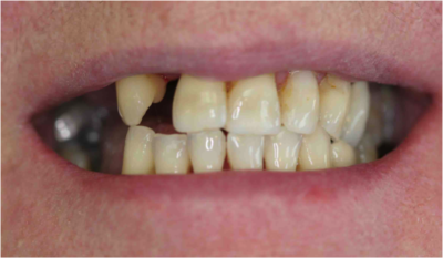 Teeth Before Gaps Missing Teeth Richmond Va