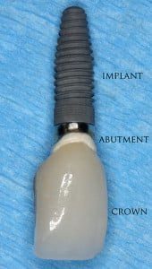 Single Crown Dental Implant