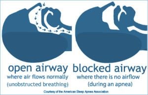 Obstructive Sleep Apnea Appliances graphics showing how sleep apnea occures