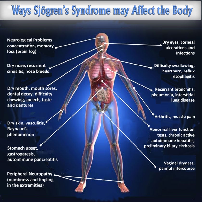 Sjogren’s Syndrome body affects