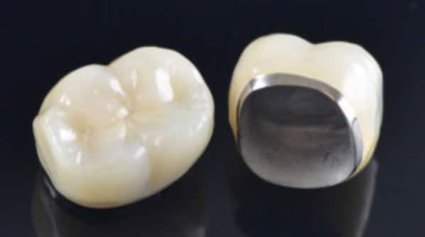 Porcelain-Fused-To-Metal-Crown-Dentist-Richmond-Va