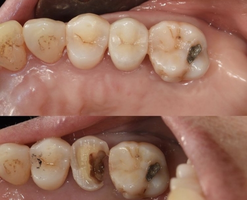 Tooth Decay And Composite Filling