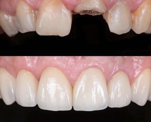 Implant Crown And Asthetic Restoration