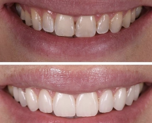 Dental Veneer Restoration
