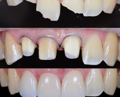 broken teeth - build up - crown Richmond VA
