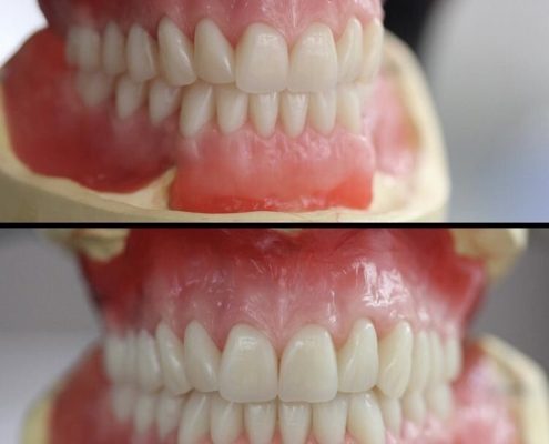Complete Denture Wax Up In Try In Phase