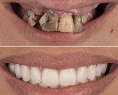 Extraction And Complete Denture