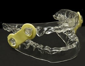 Obstructive sleep apnea treatment and device (OSA) in Richmond, VA