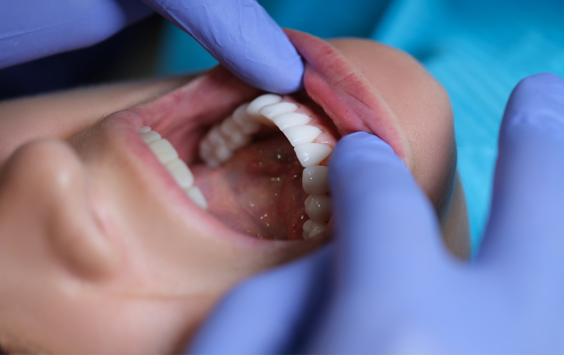 oral cancer screening smile