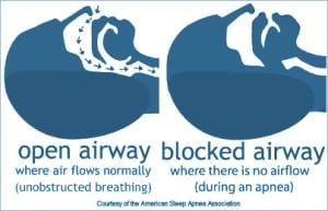 Sleep Apnea airway block image Advanced Dentistry of Richmond Women owned and operated, patient focused dental Prosthodontics practice Dr. Clara Bergeron , Dr. Ursula Klostermyer