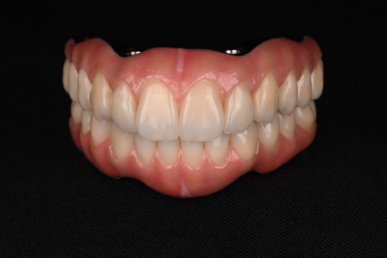 Full mouth rehabilitation implant hybrid Advanced Dentistry of Richmond Women owned business and operated, patient focused dental Prosthodontics practice