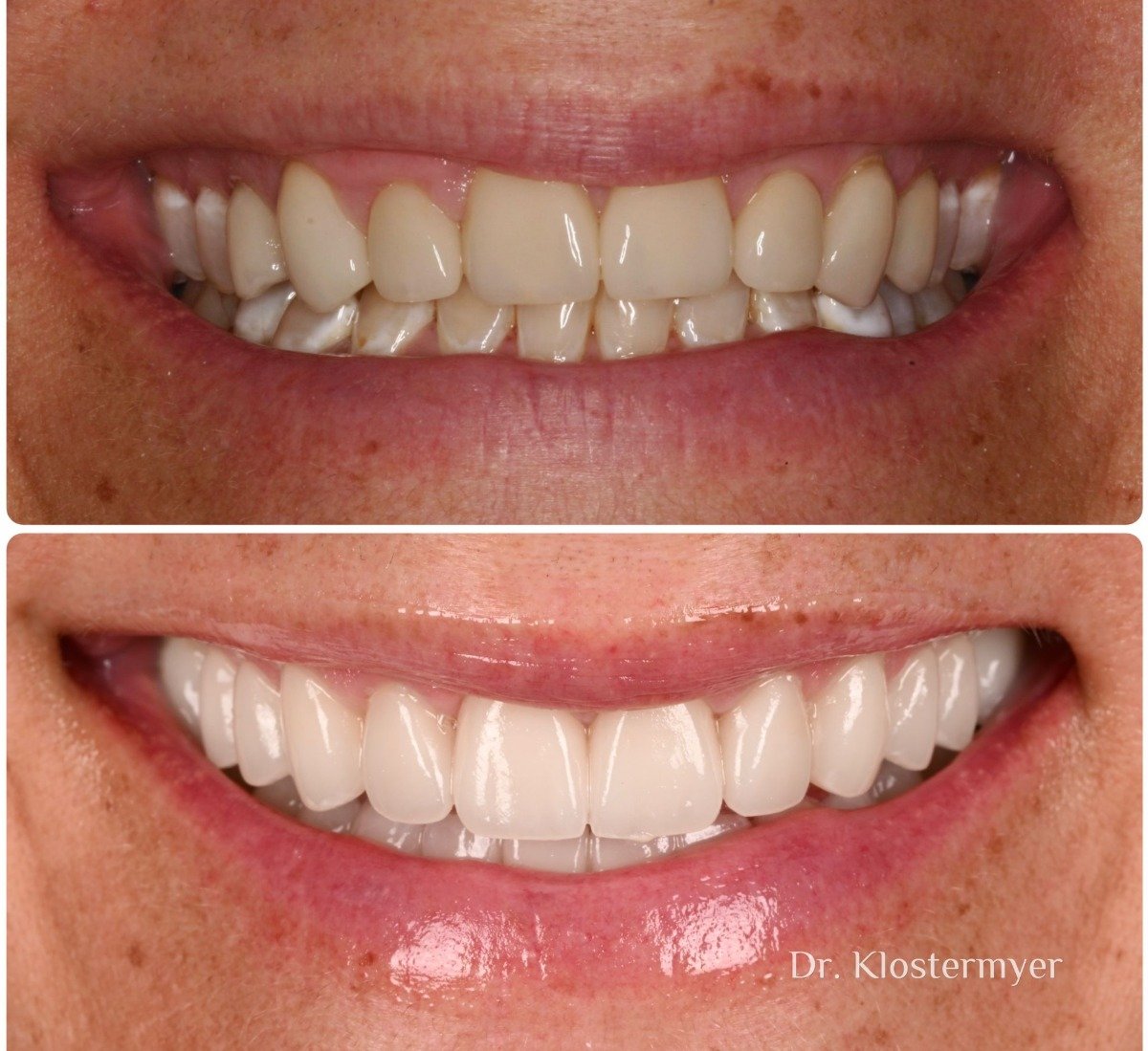 Before and after treatment for Dentist showing how new Quality Dental Veneers will look Prosthetic Specialist Richmond VA