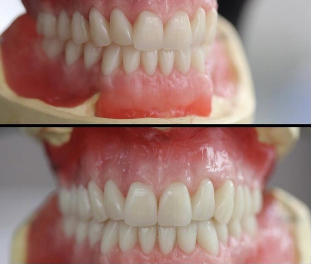 Removable Dentures photo of complete denture wax up in try in phase