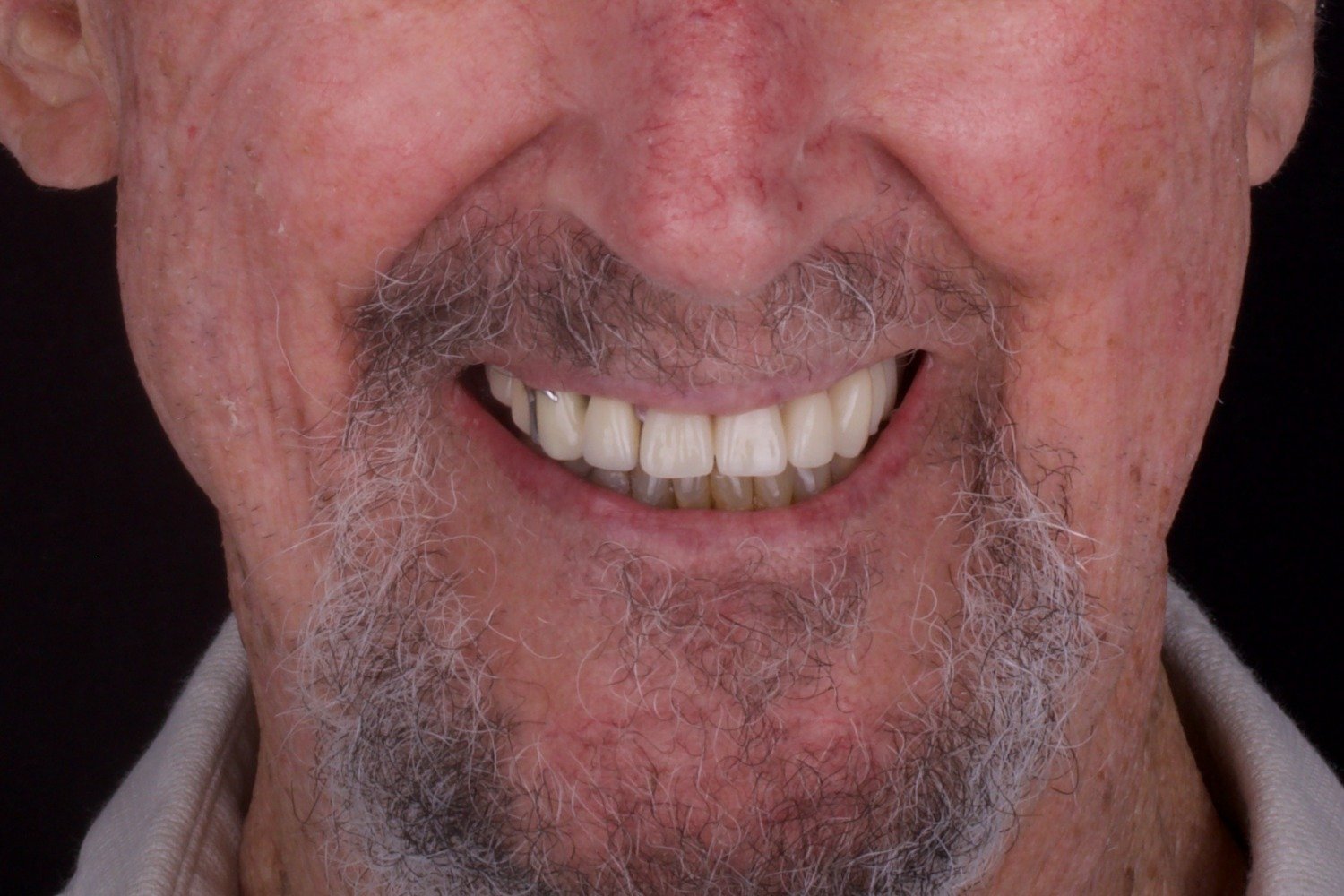 obturator after Maxillofacial prosthodontics Advanced Dentistry of Richmond Women owned and operated, dental practice, patient focused in Virginia