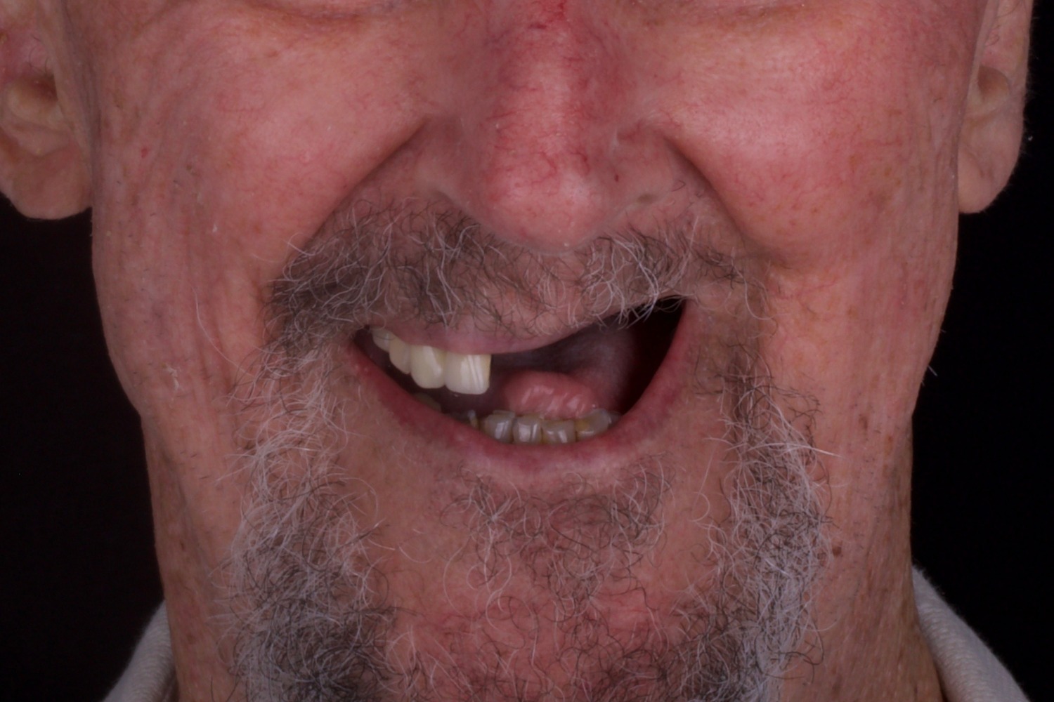 obturator before Maxillofacial Prosthodontics Dental Specialist Richmond VA