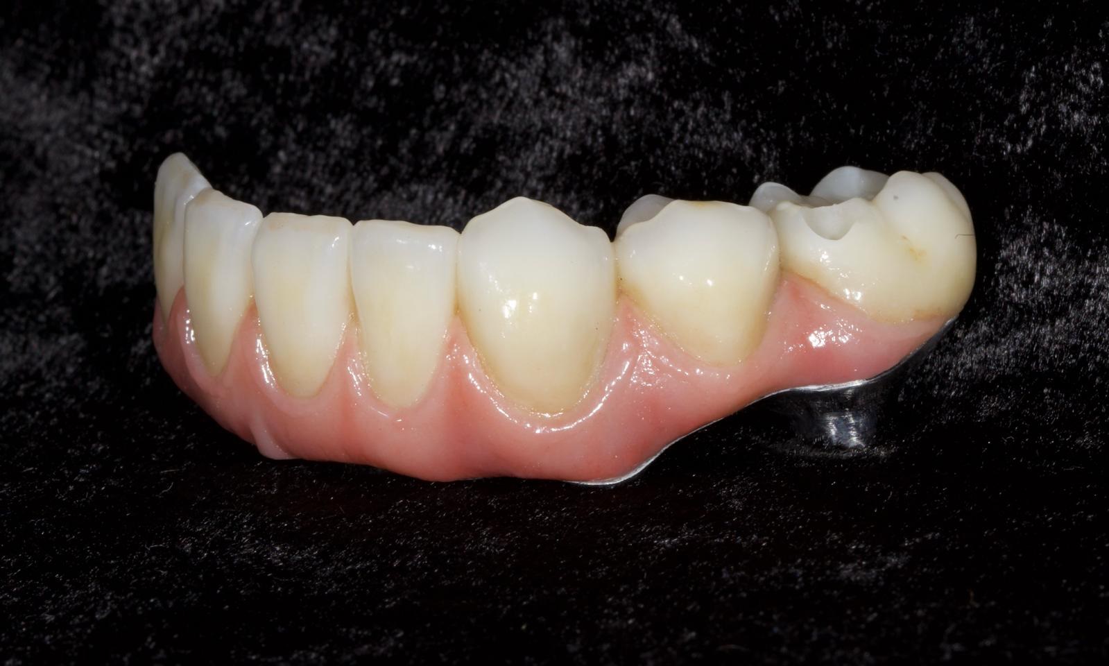 Maxillofacial Implants Advanced Dentistry of Richmond