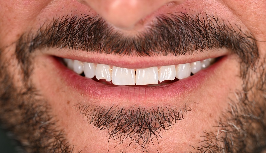 Before picture Veneers Dentist, Richmond, VA? Women owned & operated, patient focused practice, call (804) 282-7260