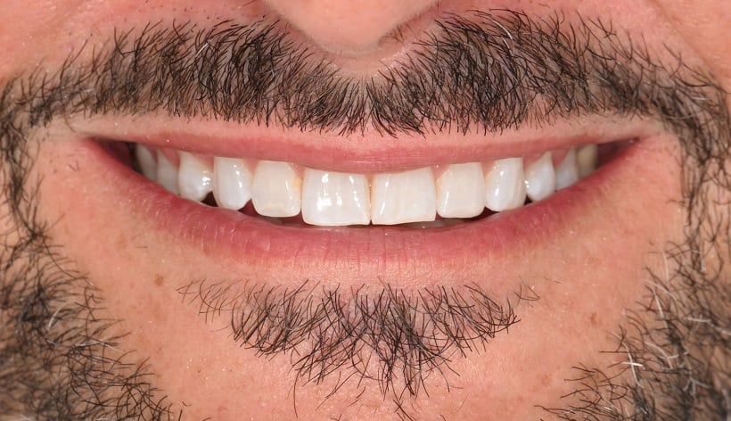 After picture Veneers Dentist, Richmond, VA? Women owned & operated, patient focused practice, call (804) 282-7260