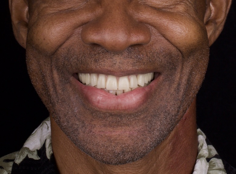 Photo of after Removable Dentures Complete dentures are custom-made removable prosthetic appliances designed to replace all missing teeth in the upper and/or lower arch. Crafted from high-quality acrylic or advanced composite materials