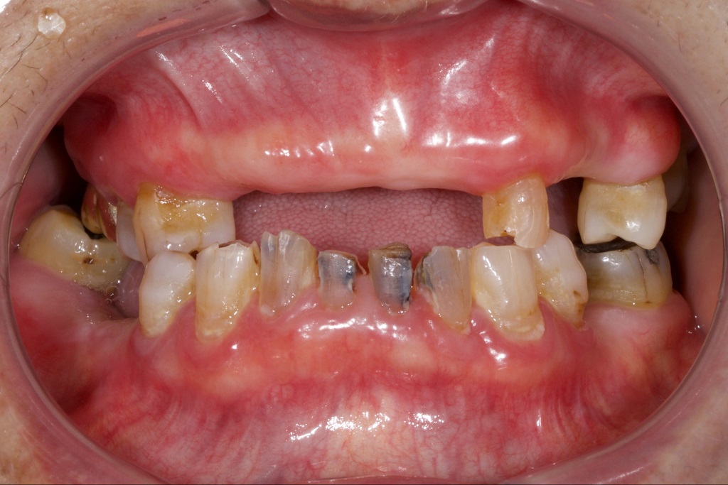 High Quality Sjogren's Syndrome Dental Treatment Virginia Dr. Clara Bergeron Dr. Ursula Klostermyer Prosthodontist Advanced Dentistry of Richmond Women owned and operated, patient focused dental Prosthodontics practice