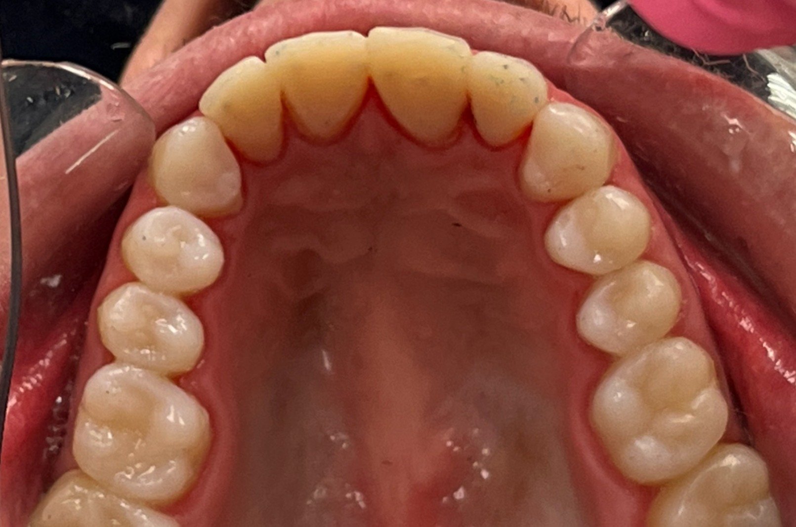 bondings after picture Full Mouth Rehabilitation bondings Advanced Dentistry of Richmond Women owned business and operated, patient focused dental Prosthodontics practice roof of mouth including teeth