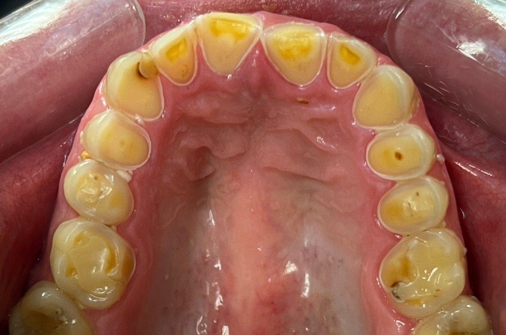 Full Mouth Rehabilitation bondings before Advanced Dentistry of Richmond Women owned business and operated, patient focused dental Prosthodontics practice