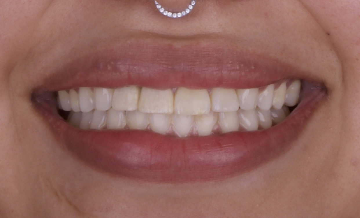 cantilever implant bridge after Advanced Dentistry of Richmond 204 Glen Forest Dr STE 203, Richmond, VA 23226