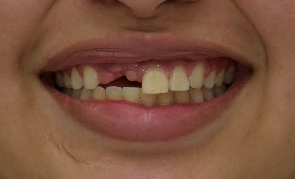 cantilever implant bridge before Advanced Dentistry of Richmond