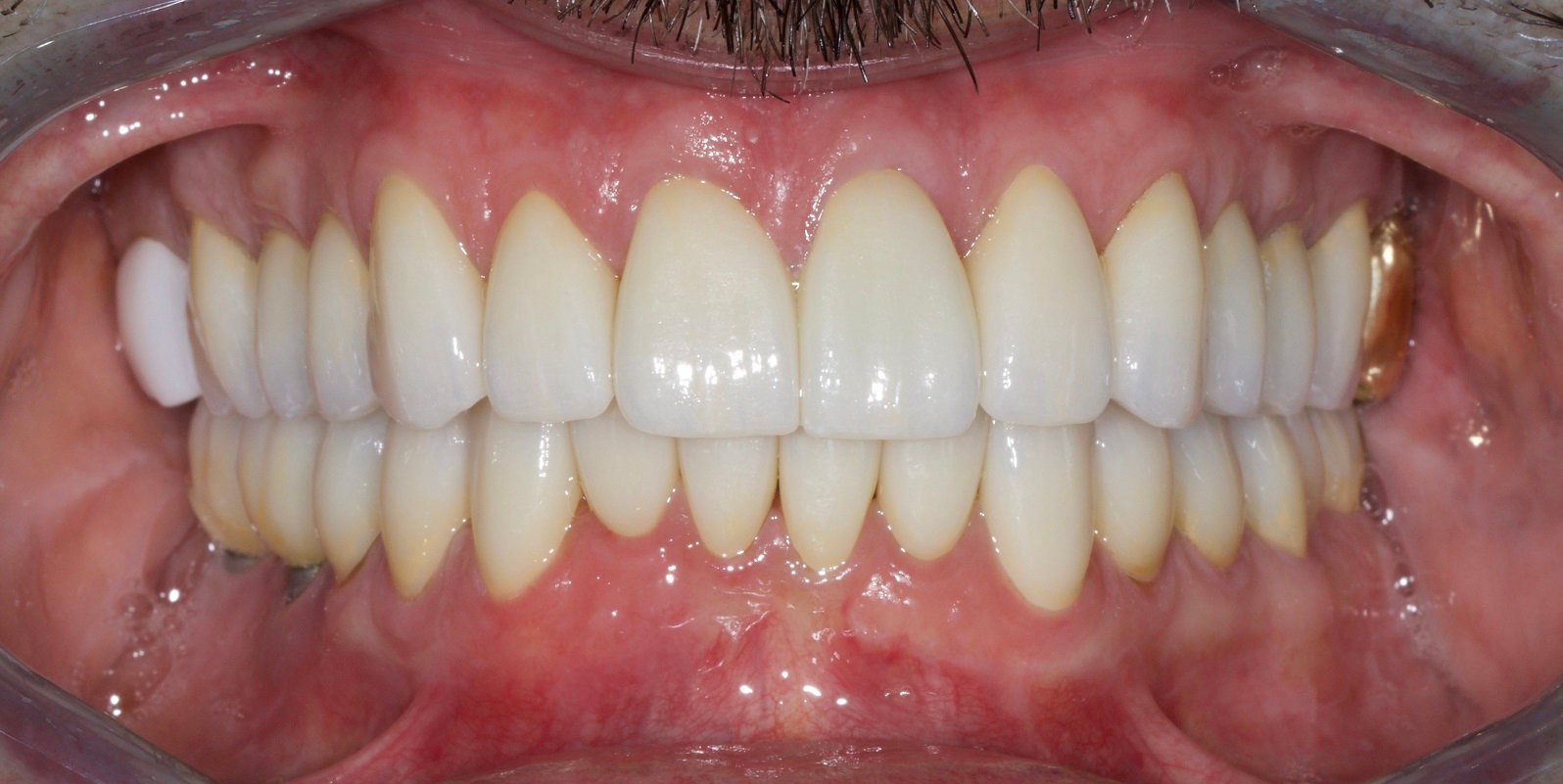 fixed rehab after picture roof of mouth including teeth Full Mouth Rehabilitation Advanced Dentistry of Richmond Women owned and operated, dental practice, patient focused