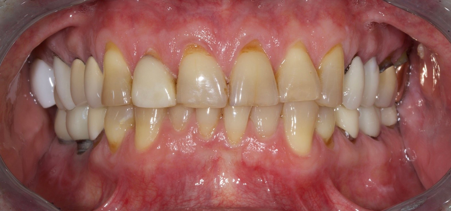 fixed rehab before picture Full Mouth Rehabilitation Advanced Dentistry of Richmond Women owned business and operated, dental practice, patient focused Prosthodontics practice roof of mouth including teeth