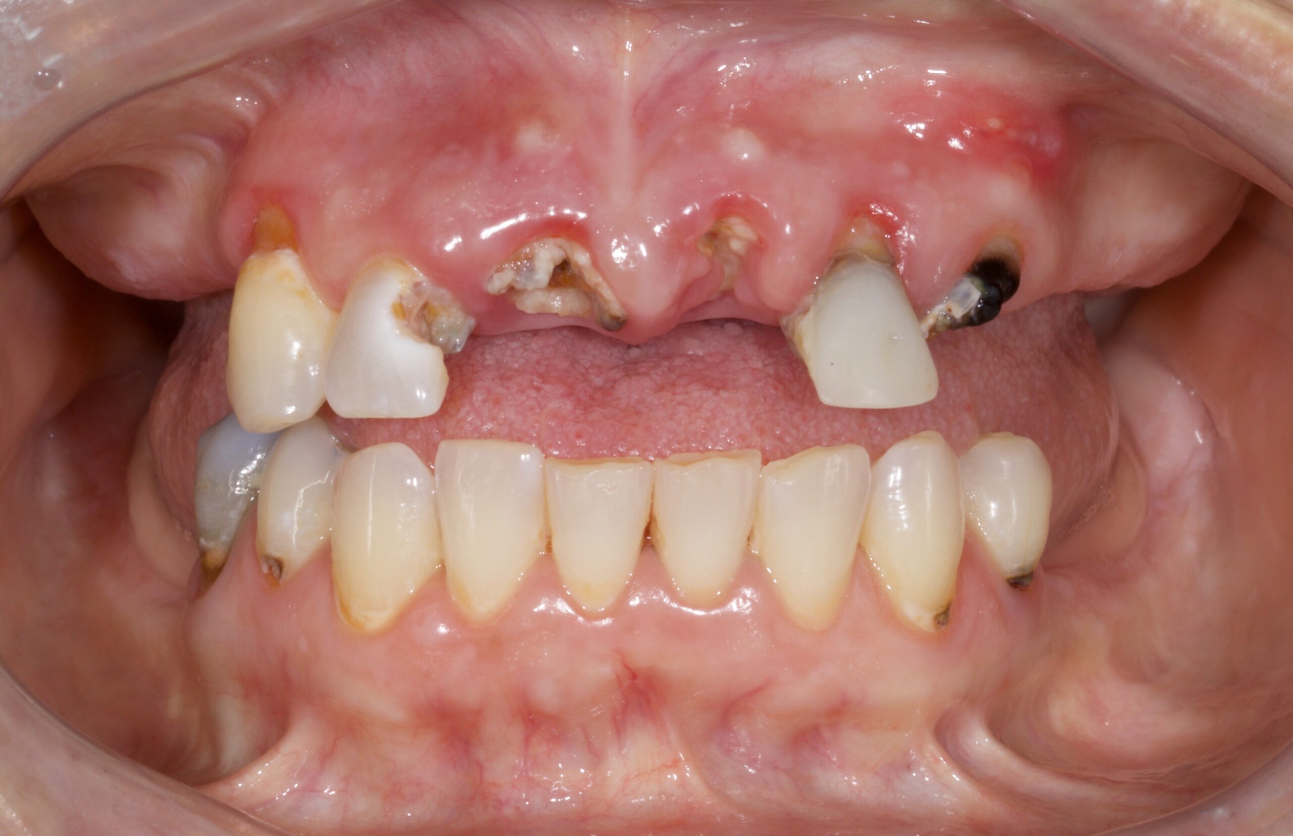 immediate denture photo of before treatment Immediate dentures are custom-made prosthetic appliances placed the very same day teeth are removed, allowing patients to leave surgery with a complete smile