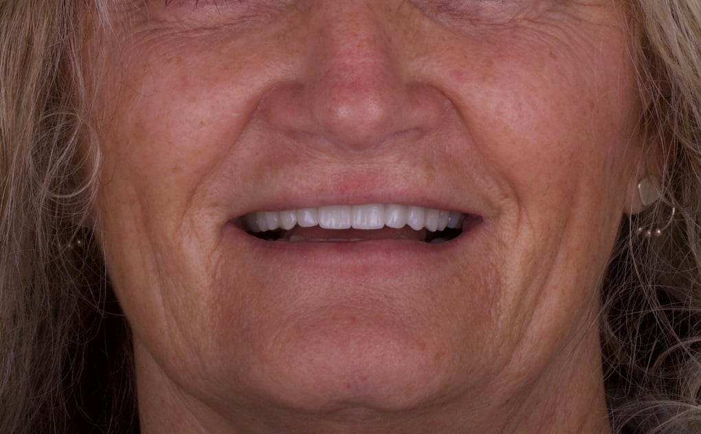 Removable Dentures photo of implant FPD after implant work Advanced Dentistry of Richmond Women owned business and operated, patient focused dental Prosthodontics practice
