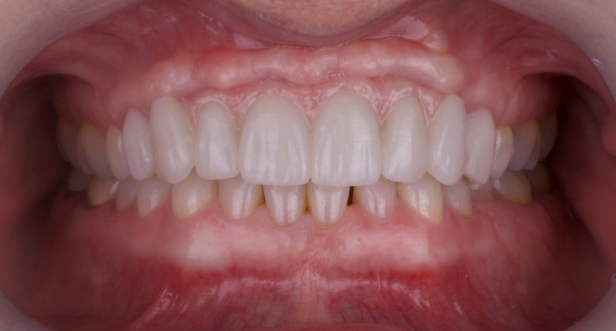 photo of implant FPD after 2 Advanced Dentistry of Richmond Women owned and operated, dental practice, patient focused Virginia
