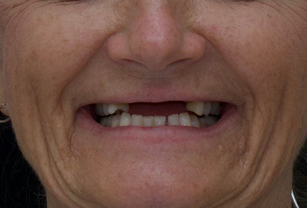 Removable Dentures photo of implant FPD before treatment Advanced Dentistry of Richmond Women owned business and operated, patient focused dental Prosthodontics practice