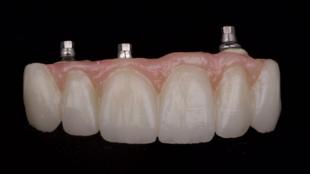 Photo of implant bridge Advanced Dentistry of Richmond Women owned and operated, dental practice, patient focused in Virginia