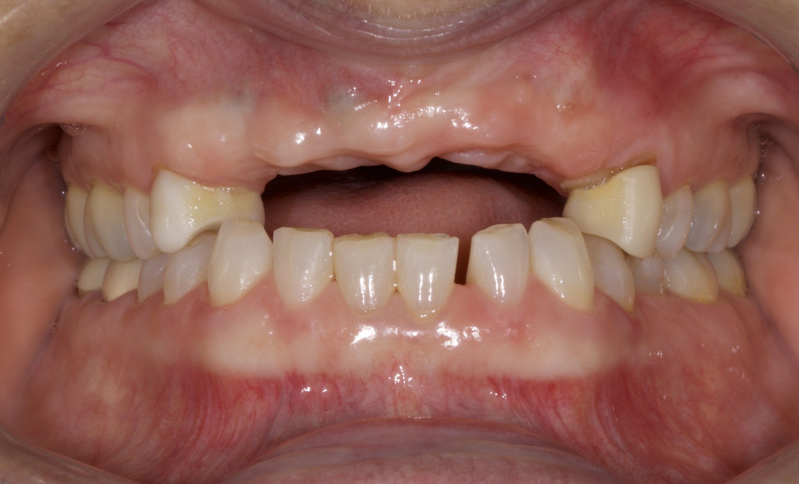 photo of iimplant bridge before Advanced Dentistry of Richmond Women owned and operated, dental practice, patient focused