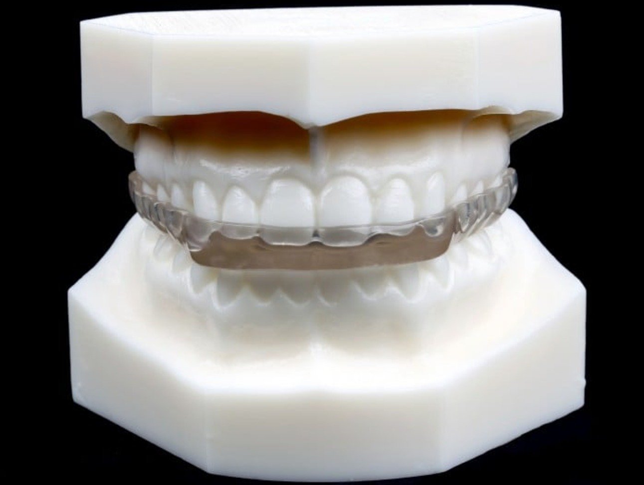 Custom dental night guard on a model, demonstrating effective treatment for bruxism and TMD at Advanced Dentistry of Richmond, VA.
